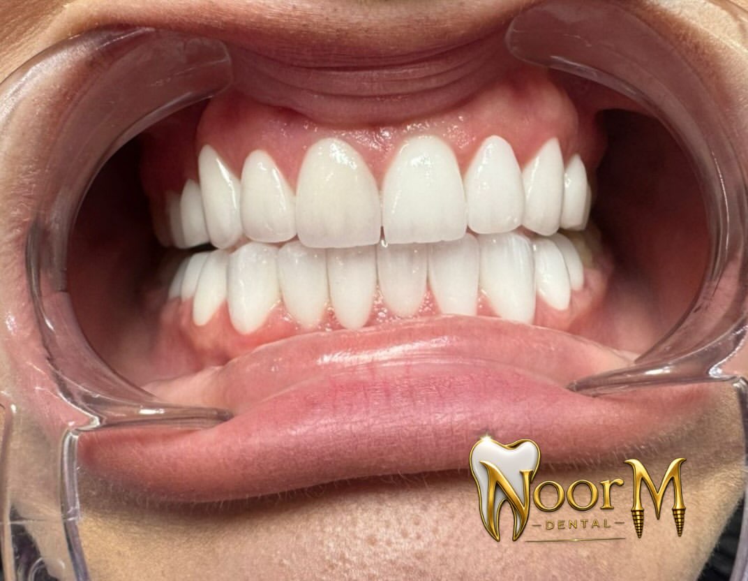 Full Mouth Ceramic Harmony